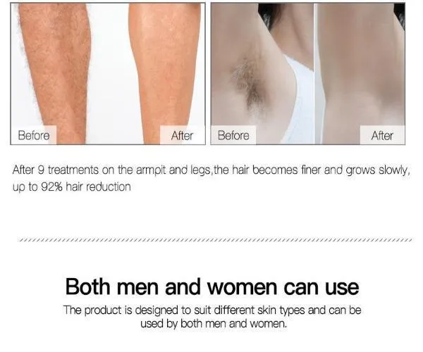 Laser Hair Removal Handset Permanent And Pain Free